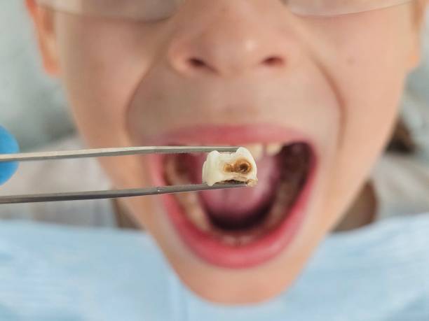 Best Emergency Tooth Extraction in Winnsboro, TX